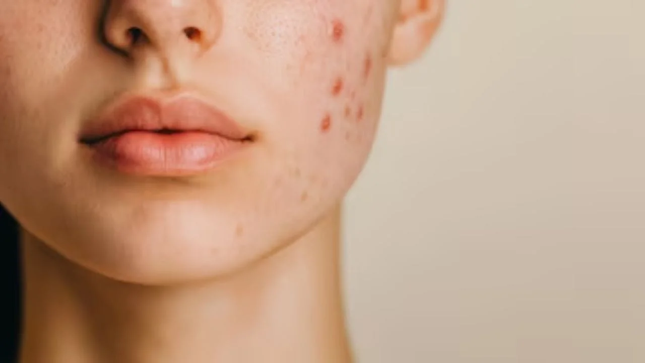 Neem Leaf Juice: A Natural Remedy to Remove Pimples Overnight